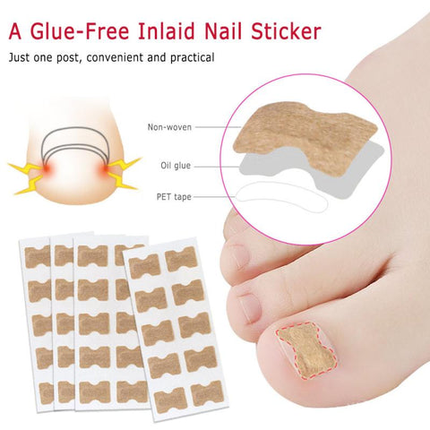 Ingrown Toenail Correction Sticker Patches - 10 Pieces