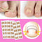Ingrown Toenail Correction Sticker Patches - 10 Pieces